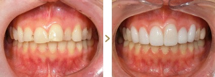 症例写真 セラミック矯正 上前歯6本 叢生、上顎前突、歯の変色、虫歯