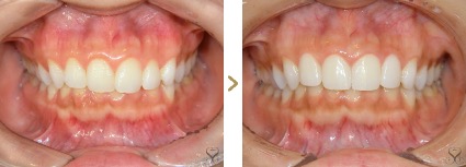 症例写真 セラミック矯正 上前歯4本 叢生、ガミースマイル