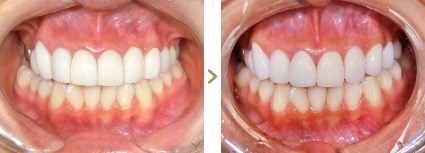 症例写真 セラミック矯正 上前歯8本 他院修正、古い差し歯、デザイン変更