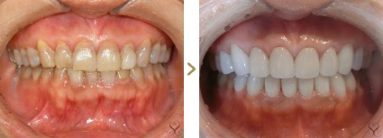 症例写真 セラミック矯正 上前歯8本、下前歯8本 テトラサイクリン歯、変色歯