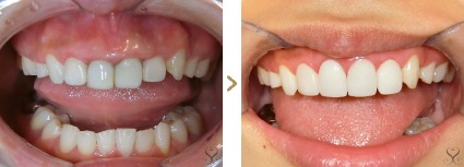 症例写真 セラミック矯正 上前歯4本 差し歯の変色、歯茎の腫れ、ガミースマイル