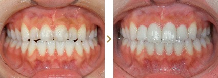 症例写真 セラミック矯正 上前歯4本 叢生、受け口、虫歯
