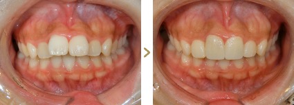 症例写真 セラミック矯正 上前歯4本 上顎前突
