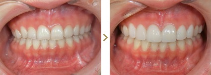 症例写真 セラミック矯正 上前歯6本 歯の欠け、ガミースマイル