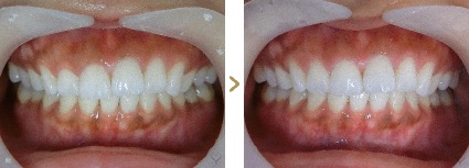 症例写真 歯肉整形 1〜3本 ガミースマイル