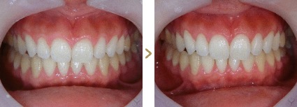 症例写真 歯肉整形 4〜6本  ガミースマイル