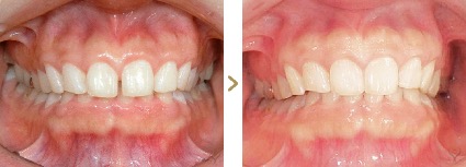 症例写真 インビザラインGo (ゴー) 症例：空隙歯列、上顎前突