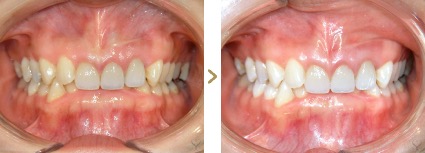 症例写真 デュアルホワイトニング 歯の着色