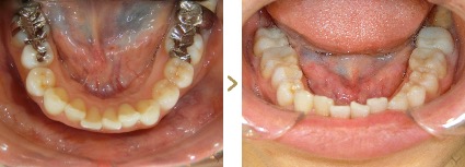 症例写真 セラミックインレー 症例：古い銀歯 治療本数：下顎5本