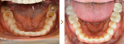 症例写真 セラミックインレー 症例：虫歯治療後 治療本数：下顎5本