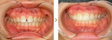 症例写真 削らないラミネートベニア 症例：上顎前突、歯の形態