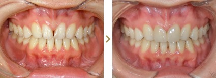 症例写真 ラミネートベニア 歯の色・形態 治療本数：2本