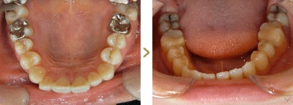 症例写真 セラミックインレー 症例：古い銀歯 治療本数：下顎2本