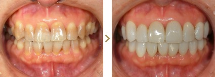 症例写真 ラミネートベニア 歯の色・形態 治療本数：16本