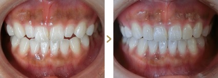 症例写真 ラミネートベニア 歯の色・形態 治療本数：2本