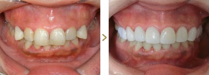 症例写真 セラミックブリッジ 症例：上顎前突、八重歯