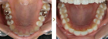 症例写真 セラミックインレー 症例：古い銀歯 治療本数：上顎4本