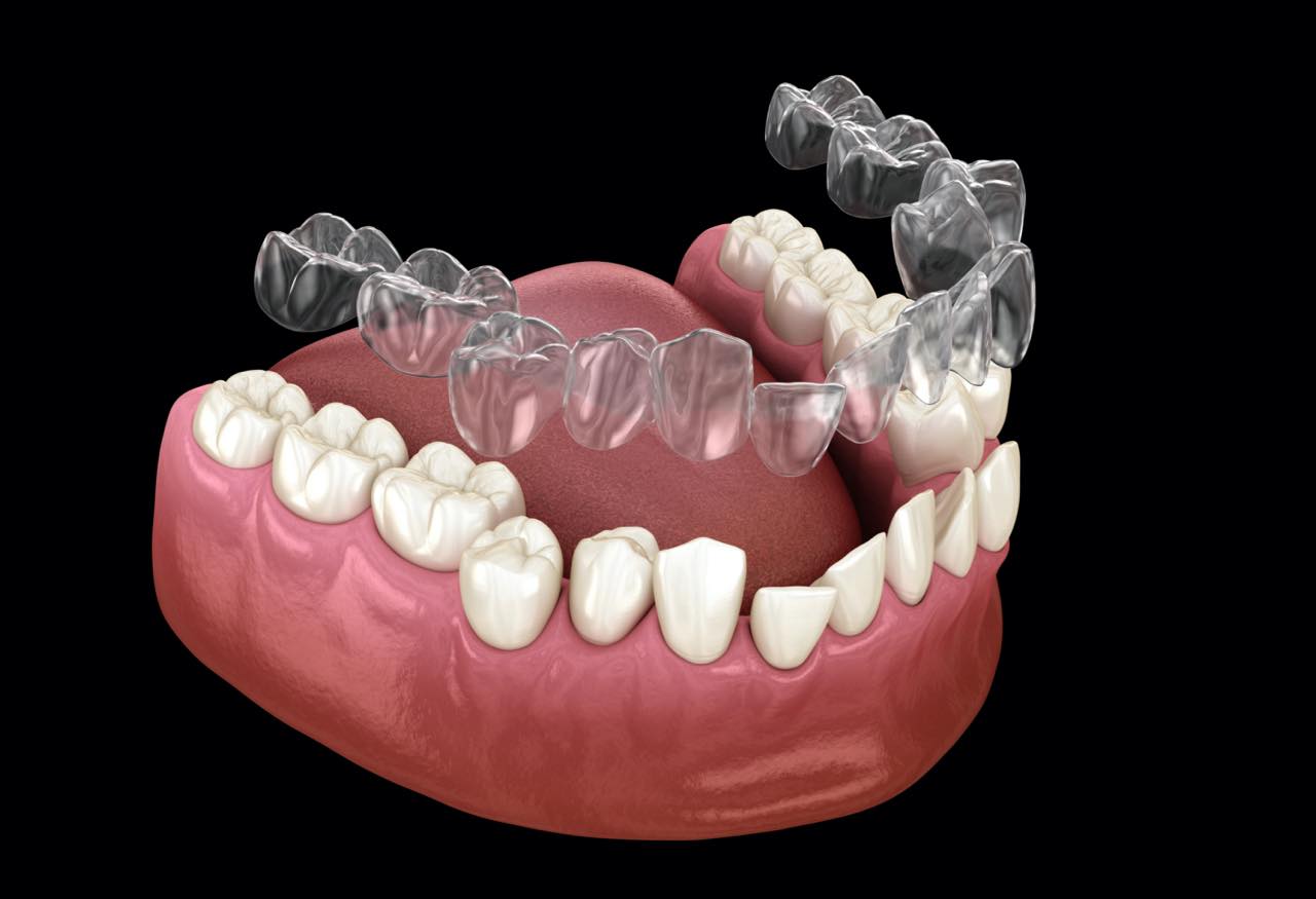 インビザラインで奥歯のマウスピースがパカパカ浮く原因と対処法