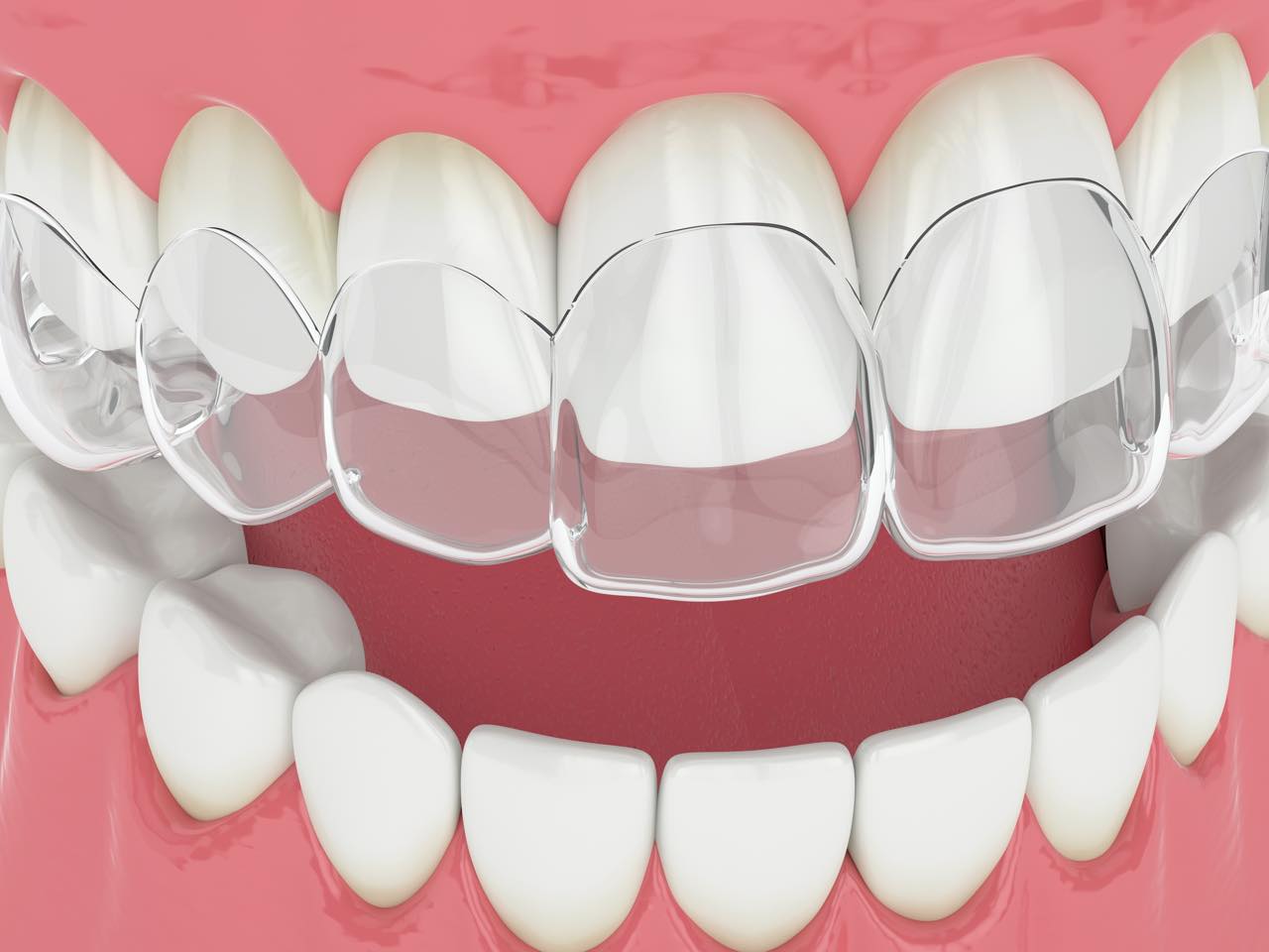 インビザラインで八重歯の矯正は適応？治療方法と注意点も解説