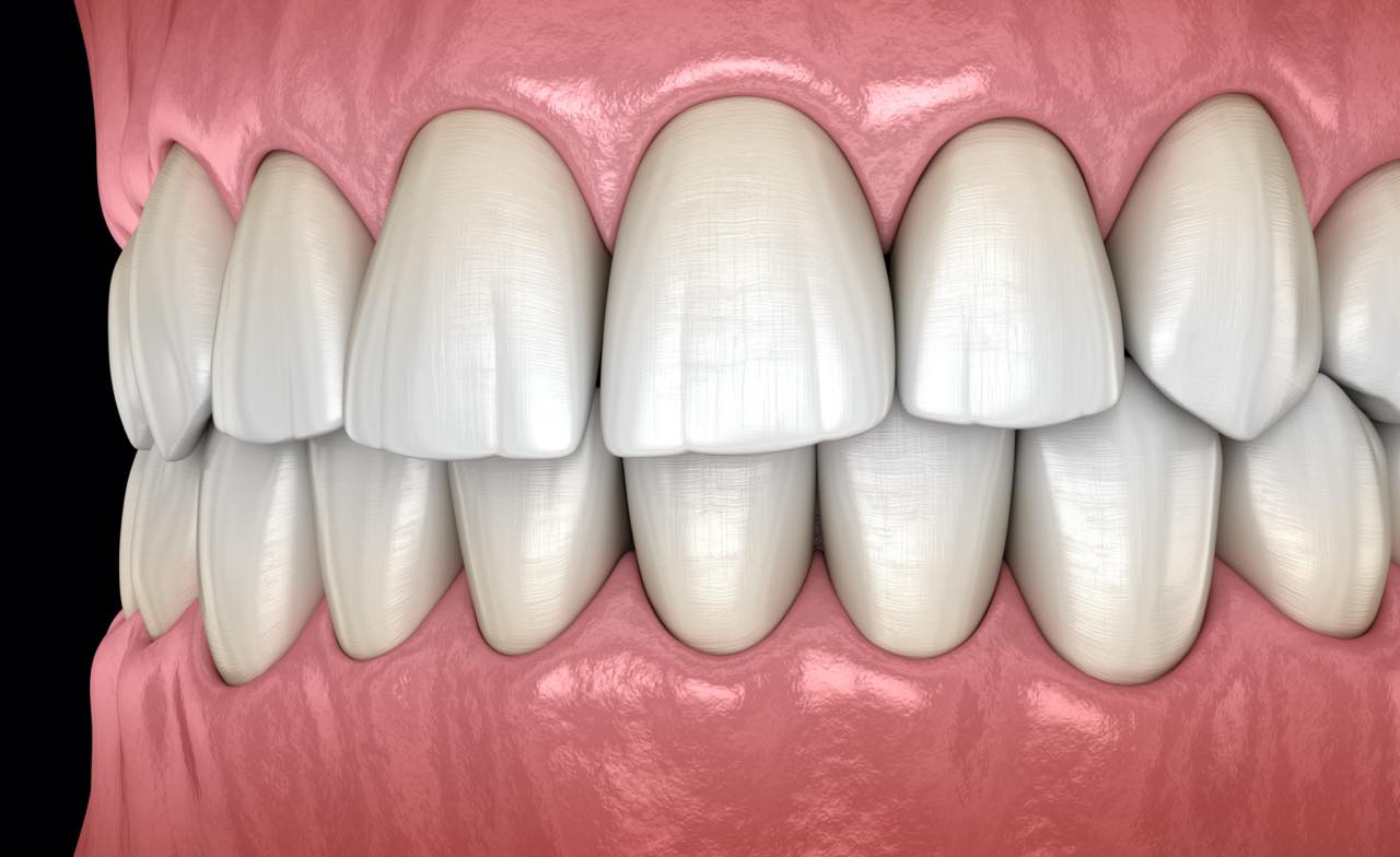 歯並びが悪い症例と治療法とは？放置のリスクについても解説