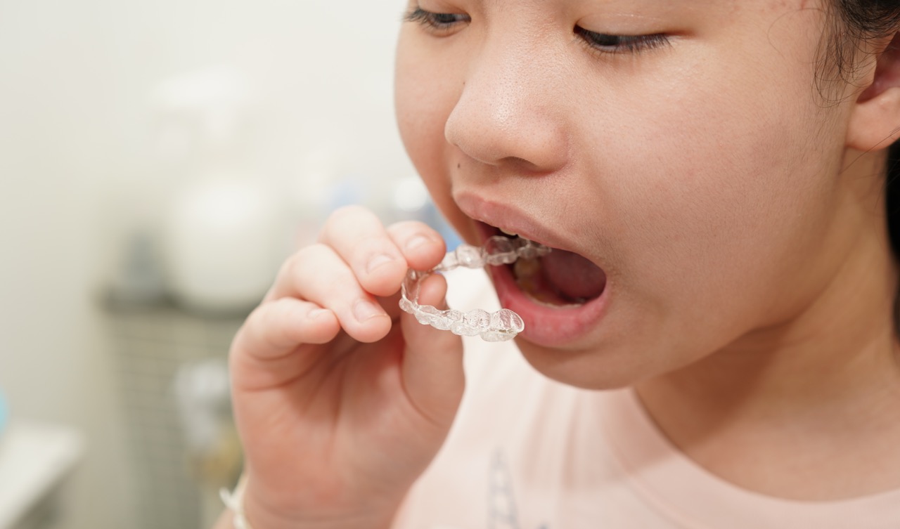 マウスピースを使った子供矯正の効果は？種類・費用・治療期間なども解説